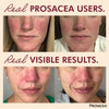 Prosacea - Heals Rosacea Symptoms of Redness, Pimples and Irritation - Twin Pack - Two 0.75oz Tubes (1.5oz Total)