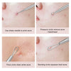 Blackhead Remover, 2 PCS Pimple Popper ?Stainless Steel Pimple Extractor Blackhead Removal Tool Risk Free Treatment for Blemish,Whitehead Popping