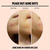 Peace Out Skincare Acne Dots. Hydrocolloid Anti-Acne Pimple Patches with Salicylic Acid and Vitamin A to Quickly Clear Blemishes (20 dots)